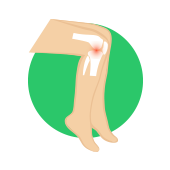 Indice algo-fonctionnel de Lequesne : arthrose du genou